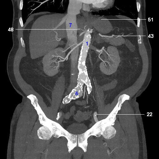 Abdominal Aorta Anatomy Ct